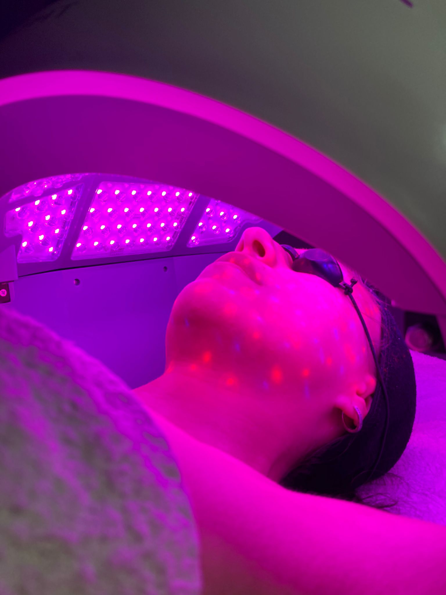 Laser Skin Resurfacing