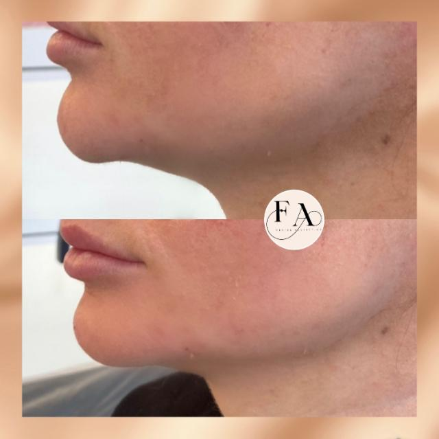 Jawline filler before and after