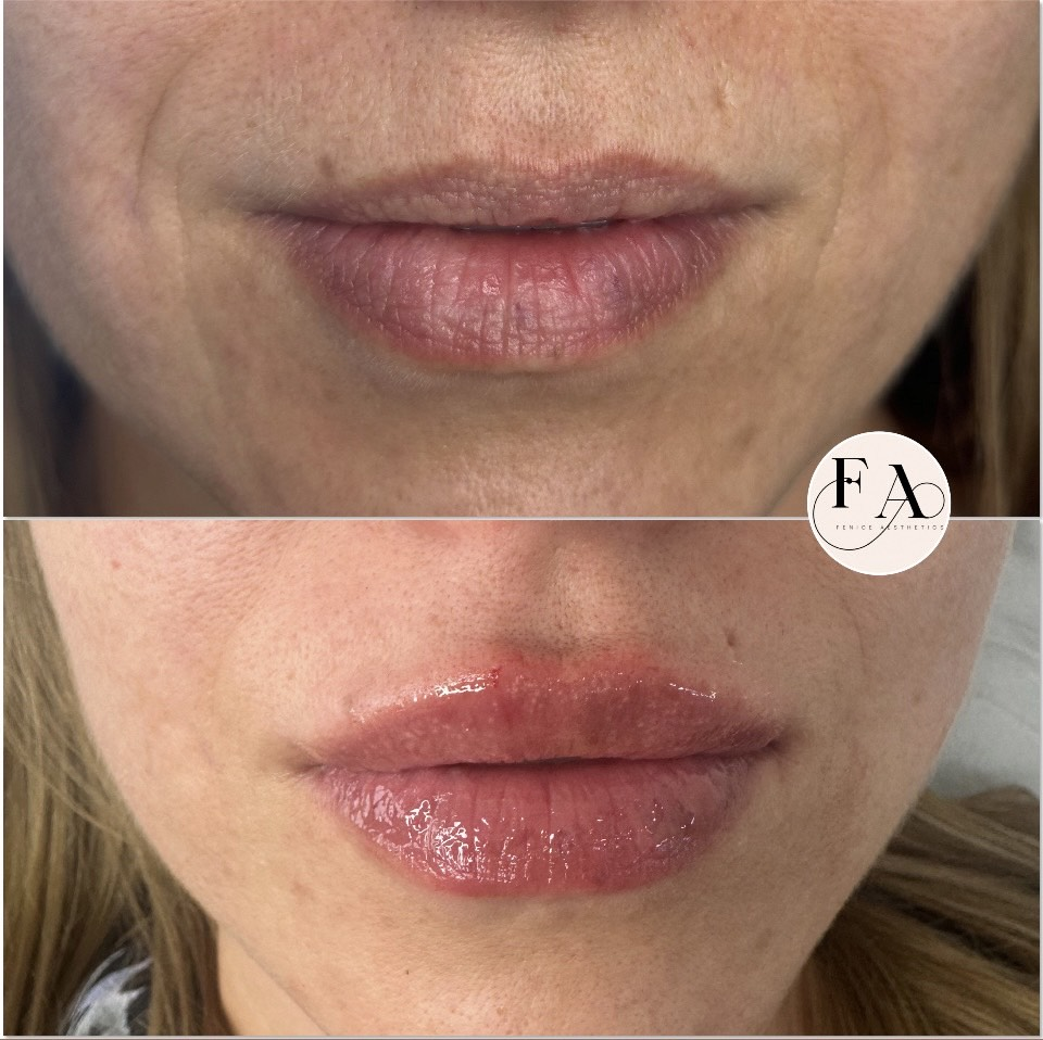 lip filler before & after picture