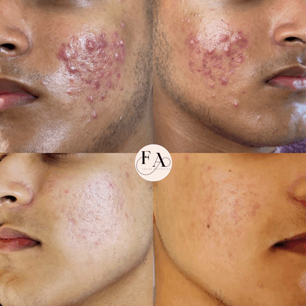 Acne treatment & Chemical Peel, before & after
